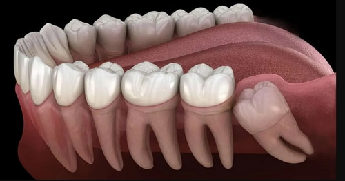 Impacted wisdom teeth can lead to jaw pain, cheek-biting, and affect facial symmetry over time. (Pinterest) Impacted wisdom teeth can lead to jaw pain, cheek-biting, and affect facial symmetry over time. (Pinterest)