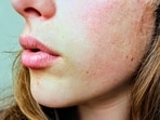 World Cancer Day 2025: Lip cancer, mostly caused by excessive exposure to the sun, can be drastic if not detected early. World Cancer Day 2025: Lip cancer, mostly caused by excessive exposure to the sun, can be drastic if not detected early.