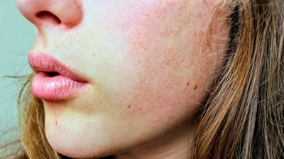 World Cancer Day 2025: Lip cancer, mostly caused by excessive exposure to the sun, can be drastic if not detected early. (Pexels) World Cancer Day 2025: Lip cancer, mostly caused by excessive exposure to the sun, can be drastic if not detected early. (Pexels)