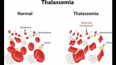 Thalassemia disorder affects the production of hemoglobin and healthy red blood cells (Sourced) Thalassemia disorder affects the production of hemoglobin and healthy red blood cells (Sourced)