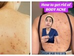 Back acnes are treated with exfoliating acids to treat the clogged pores. Back acnes are treated with exfoliating acids to treat the clogged pores.