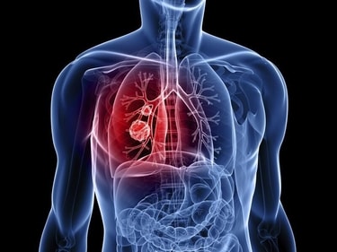 Having radiotherapy once a day for six and a half weeks or twice a day for three weeks, when combined with chemotherapy, is equally good at treating small cell lung cancer that hasn’t spread. (iStockphoto) Having radiotherapy once a day for six and a half weeks or twice a day for three weeks, when combined with chemotherapy, is equally good at treating small cell lung cancer that hasn’t spread. (iStockphoto)