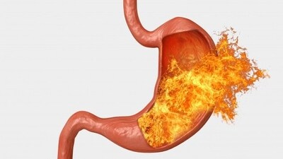 Acid reflux management guide: Causes, symptoms, effective treatment options and prevention tips to avoid esophageal cancer. (Image by Freepik) Acid reflux management guide: Causes, symptoms, effective treatment options and prevention tips to avoid esophageal cancer. (Image by Freepik)