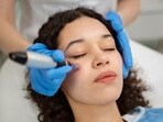 Microneedling is one of the most effective ways to naturally boost collagen and improve skin quality. (Representative picture: Freepik) Microneedling is one of the most effective ways to naturally boost collagen and improve skin quality. (Representative picture: Freepik)