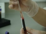 New blood cancer treatment offers hope for 600 patients annually in England. 