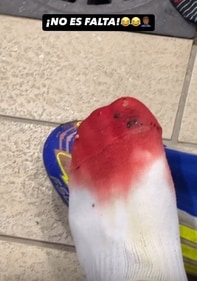 Lamine Yamal uploaded a photo of his bloodied foot (Instagram/@lamineyamal)