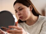 Acne-prone skin requires extra care. Acne-prone skin requires extra care.