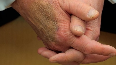 When Trump and Macron sat in front of reporters and gave each other a long, awkward handshake, the bruise - which was disguised with makeup - was noticed. X users offered their own hypotheses on the potential source of the bruise after a close-up of Trump's hand showed discoloration. (AP/X)