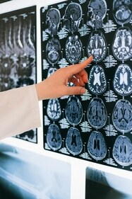 The study introduces a deep learning approach to measure brain ageing speed. (Pexels) The study introduces a deep learning approach to measure brain ageing speed. (Pexels)