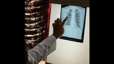 The step will be crucial in India achieving its TB elimination target of 2025, five years ahead of the global target of 2030 under the sustainable development goals. (AFP) The step will be crucial in India achieving its TB elimination target of 2025, five years ahead of the global target of 2030 under the sustainable development goals. (AFP)