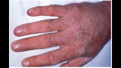 The signal is clear, human skin is progressively unable to bear the extreme heat of the sun (Wikipedia) The signal is clear, human skin is progressively unable to bear the extreme heat of the sun (Wikipedia)