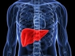 Guidelines recommend diet and exercise for treating metabolic-associated fatty liver disease. 
