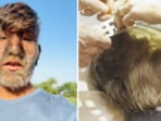 Lalit Patidar, 18, has hypertrichosis, a rare condition with only 50 documented cases globally.