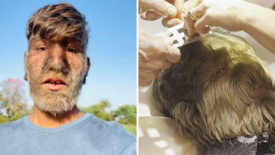 Lalit Patidar, 18, has hypertrichosis, a rare condition with only 50 documented cases globally. (Instagram/ lalitpatidar520) Lalit Patidar, 18, has hypertrichosis, a rare condition with only 50 documented cases globally. (Instagram/ lalitpatidar520)