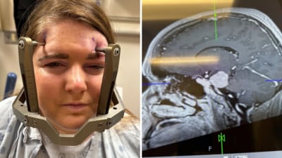 After suffering severe facial pain, Nicola Shaw discovered she had a meningioma, a rare brain tumor. (braintumourresearch.org)