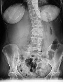 Stiff person syndrome causes unnatural curvature in the spine (Shutterstock) Stiff person syndrome causes unnatural curvature in the spine (Shutterstock)