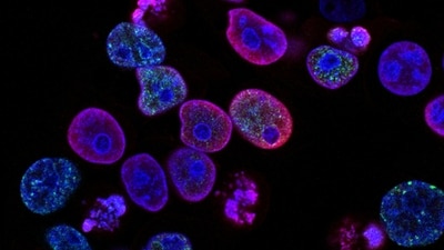 A study reveals that cancer cells suppress poison exons, leading to increased tumor growth. (Unsplash) A study reveals that cancer cells suppress poison exons, leading to increased tumor growth. (Unsplash)