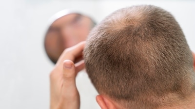 Oral minoxidil emerges as convenient treatment for hair loss, dermatologists say. (Freepik) Oral minoxidil emerges as convenient treatment for hair loss, dermatologists say. (Freepik)