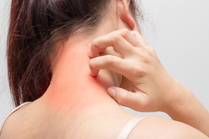 Scratching an itch can worsen skin allergies. (Shutterstock) Scratching an itch can worsen skin allergies. (Shutterstock)