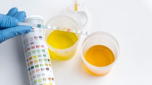 A dark yellow colour usually means you are dehydrated while a reddish urine could indicate cancer. (Freepik) A dark yellow colour usually means you are dehydrated while a reddish urine could indicate cancer. (Freepik)