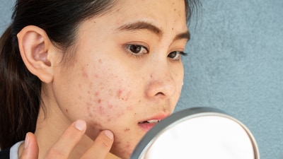 Adult acne occurs after the teenage years in twenties or thirties. (Shutterstock) Adult acne occurs after the teenage years in twenties or thirties. (Shutterstock)