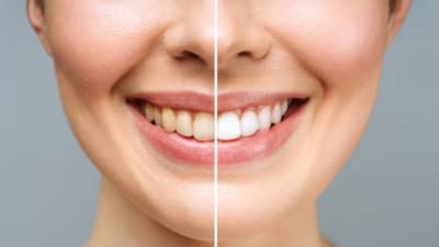 Most whitening products use chemicals to bleach your teeth. (Representative picture: Freepik) Most whitening products use chemicals to bleach your teeth. (Representative picture: Freepik)