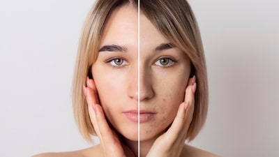 Hyperpigmentation is a common skin concern that affects many individuals, causing uneven skin tone and dark patches. (Freepik ) Hyperpigmentation is a common skin concern that affects many individuals, causing uneven skin tone and dark patches. (Freepik )