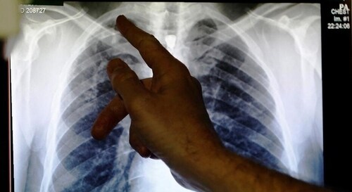 Tuberculosis can cause severe damage to the lungs, leaving patients with health issues, such as shortness of breath, for years after the infection is cured (Luke MacGregor/REUTERS ) Tuberculosis can cause severe damage to the lungs, leaving patients with health issues, such as shortness of breath, for years after the infection is cured (Luke MacGregor/REUTERS )