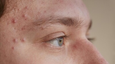 The manufacturing worker quit his job after a month, citing a pimple as a health issue (Representational) The manufacturing worker quit his job after a month, citing a pimple as a health issue (Representational)