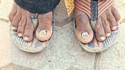 Mysterious malady in Buldhana: After hair loss, villagers lose nails Mysterious malady in Buldhana: After hair loss, villagers lose nails