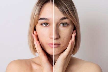The dark spots worsen in summer. (Freepik ) The dark spots worsen in summer. (Freepik )