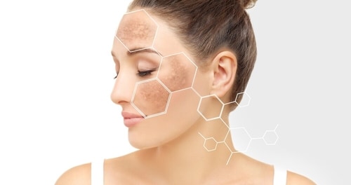 Hyperpigmentation is usually in patches. (Shutterstock) Hyperpigmentation is usually in patches. (Shutterstock)