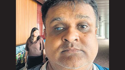 Chetan Tolia underwent surgeries after a 2017 road accident in Hyderabad Chetan Tolia underwent surgeries after a 2017 road accident in Hyderabad