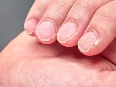 If your nails break easily, that means you have calcium deficiency. (Shutterstock) If your nails break easily, that means you have calcium deficiency. (Shutterstock)