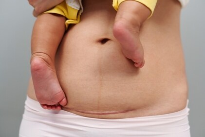 After a C-section surgery, women may experience different types of pain and discomfort. (Shutterstock) After a C-section surgery, women may experience different types of pain and discomfort. (Shutterstock)