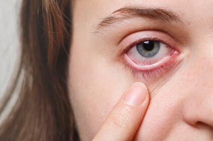 Extreme summer has arrived early in most parts of the country as dangerously high temperatures have been recorded in many states like West Bengal, Bihar and Andhra Pradesh. Extreme heat can take a toll on your eye health too with redness, itchiness and burning sensation becoming more common. (Image by Freepik) Extreme summer has arrived early in most parts of the country as dangerously high temperatures have been recorded in many states like West Bengal, Bihar and Andhra Pradesh. Extreme heat can take a toll on your eye health too with redness, itchiness and burning sensation becoming more common. (Image by Freepik)