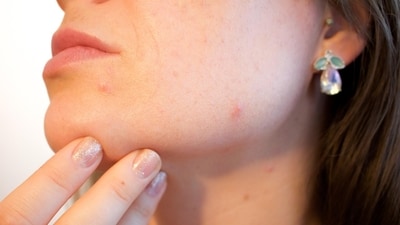 Here's how Ayurveda and Homeopathy offer a natural path to beat acne and achieve clearer skin. (Image by Pixabay) Here's how Ayurveda and Homeopathy offer a natural path to beat acne and achieve clearer skin. (Image by Pixabay)