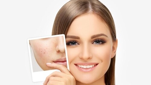 Lasers can provide 60-70% improvement in your acne scars. However, there is no such thing as 100% improvement. Regardless of the treatment, you can’t completely remove the scar. (Getty Images/iStockphoto) Lasers can provide 60-70% improvement in your acne scars. However, there is no such thing as 100% improvement. Regardless of the treatment, you can’t completely remove the scar. (Getty Images/iStockphoto)
