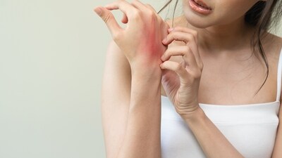 Emma Simms struggled with itchy skin for months before doctors diagnosed her with cancer. (Representational) Emma Simms struggled with itchy skin for months before doctors diagnosed her with cancer. (Representational)