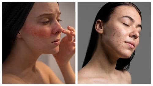 Over-exfoliation results in irritated redness, while under-exfoliation causes dull and uneven skin tone. (PC: Freepik)
