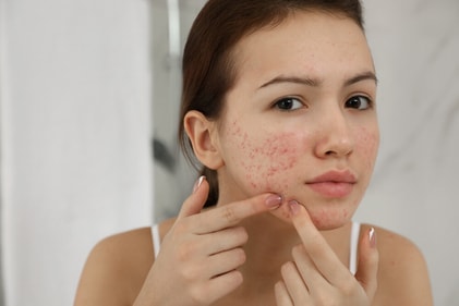 Pillowcase is the breeding ground for bacteria that triggers acne. (Shutterstock)