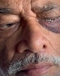 Lab investigation showed Rajendra Hardayal Guptawas suffering from an infection in his left eye caused by Pseudomonas aeruginosa – a virulent bacterium known to cause rapid and permanent vision loss if not treated promptly Lab investigation showed Rajendra Hardayal Guptawas suffering from an infection in his left eye caused by Pseudomonas aeruginosa – a virulent bacterium known to cause rapid and permanent vision loss if not treated promptly