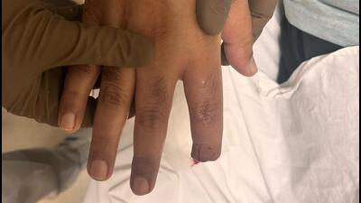 Man bites neighbour’s finger off over society bench Man bites neighbour’s finger off over society bench