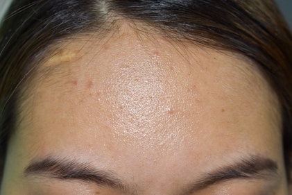 Hairline acne occurs on your forehead, near the scalp. (Shutterstock) Hairline acne occurs on your forehead, near the scalp. (Shutterstock)