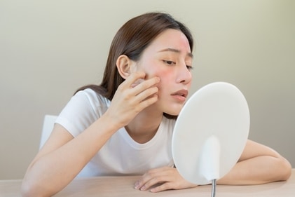 Do not touch your face, it worsens your acne-prone skin. (Shutterstock) Do not touch your face, it worsens your acne-prone skin. (Shutterstock)