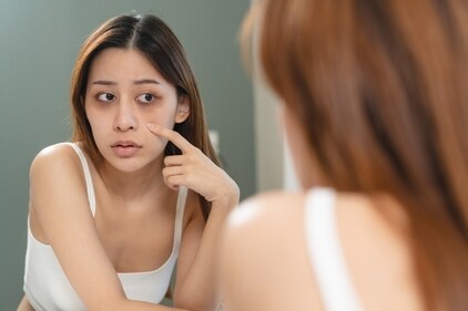 Dark circles are not just a cosmetic issue. (Shutterstock) Dark circles are not just a cosmetic issue. (Shutterstock)