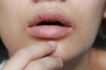 Small cracks around the mouth that sting. (Shutterstock) Small cracks around the mouth that sting. (Shutterstock)