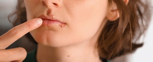 Herpes virus can hijack the immune system for reactivation. (Shutterstock) Herpes virus can hijack the immune system for reactivation. (Shutterstock)