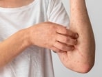 Photodermatitis is often mistaken for sunburn. Photodermatitis is often mistaken for sunburn.