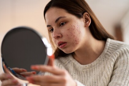 Acne-prone skin requires extra care. (Freepik)